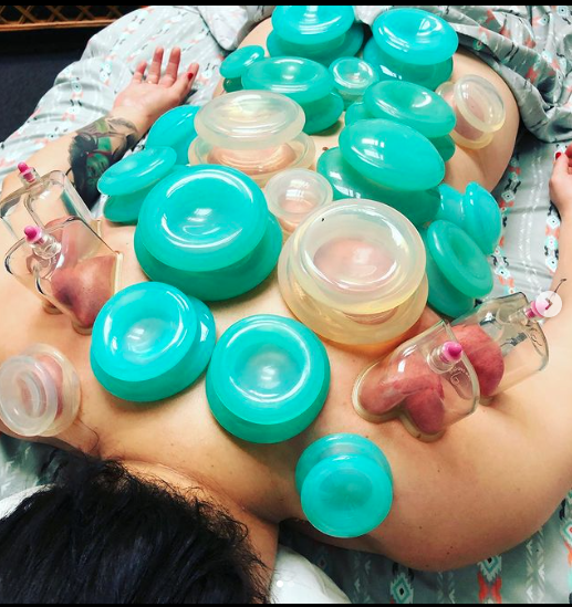 Woman enjoying cupping therapy